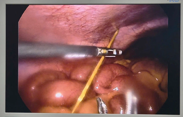 Đau bụng dữ dội, bác sĩ phát hiện thứ "đáng sợ" 4cm nằm bên trong bụng - Ảnh 1.