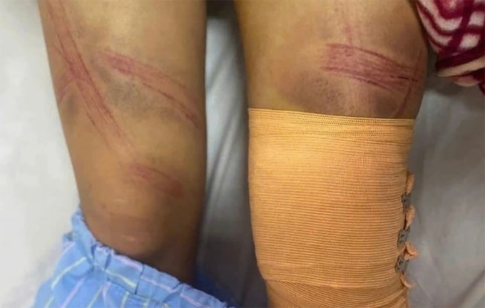 Vết thương trên người bé gái do bị bố đánh. Ảnh: Hùng Lê