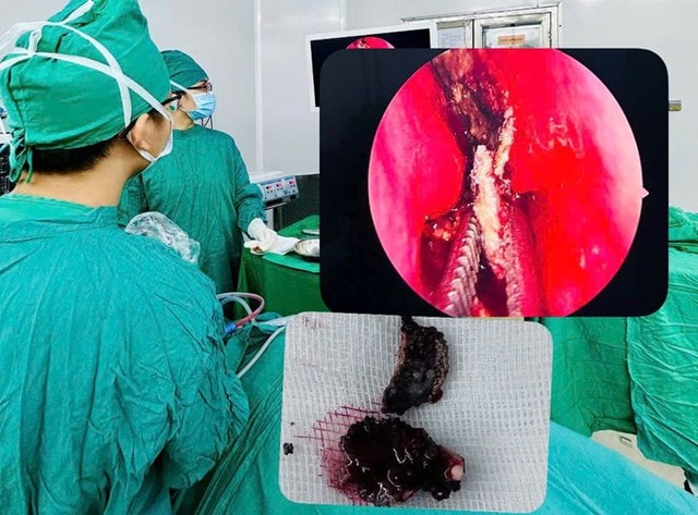 Chảy nước mũi hôi nhiều năm, bệnh nhân 23 tuổi đi khám bác sĩ gắp ra thứ "đáng sợ"- Ảnh 1.