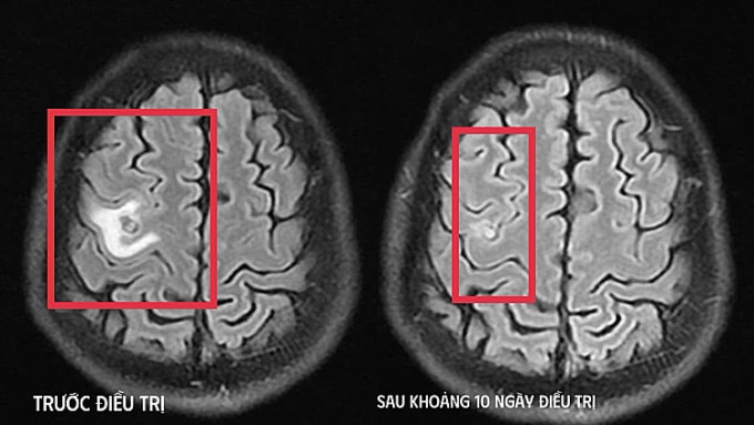 Hình ảnh chụp chiếu trước và sau khi điều trị. Ảnh: Bệnh viện cung cấp