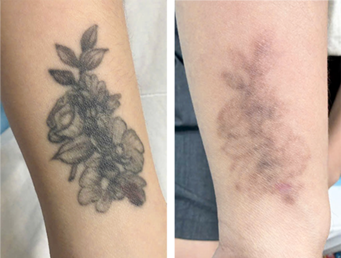 Hình xăm của chị Mai mờ đi đáng kể sau 9 lần xóa bằng laser pico. Ảnh: Bệnh viện Đa khoa Tâm Anh