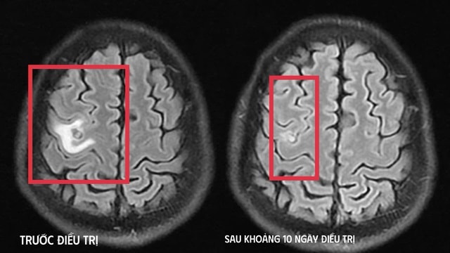 Cơn co giật bất thường hé lộ “vị khách lạ” ký sinh trong não- Ảnh 1.