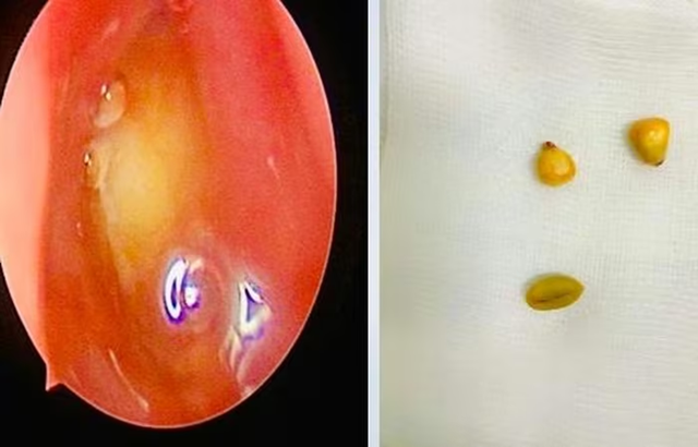 Bé trai hơn 2 tuổi chảy mũi, đến viện bác sĩ gắp ra thứ "đáng sợ" bên trong - Ảnh 1.