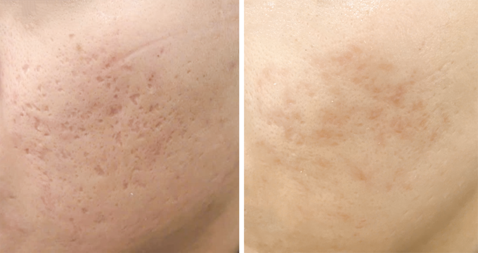 Vùng da của anh Vũ đã phẳng khoảng 60% sau một lần tách đáy sẹo và điều trị bằng công nghệ RF. Ảnh: Phòng khám Đa khoa Tâm Anh Quận 7