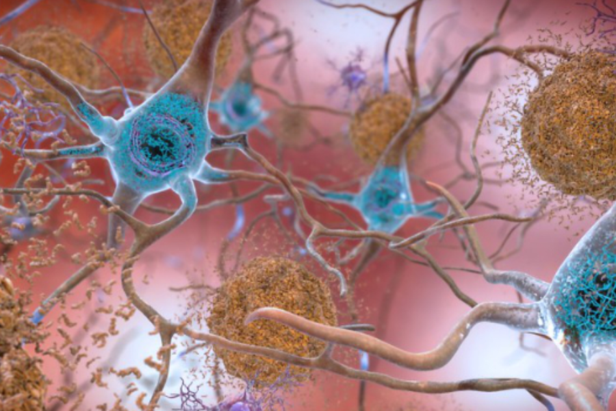 Hình minh họa các mảng protein amyloid-beta, màu cam. ( NIH/Flickr/PD )