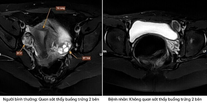 Các xét nghiệm chụp chiếu không thấy hình ảnh buồng trứng, tử cung mà lại phát hiện tinh hoàn nằm lạc chỗ. Ảnh: Bệnh viện cung cấp