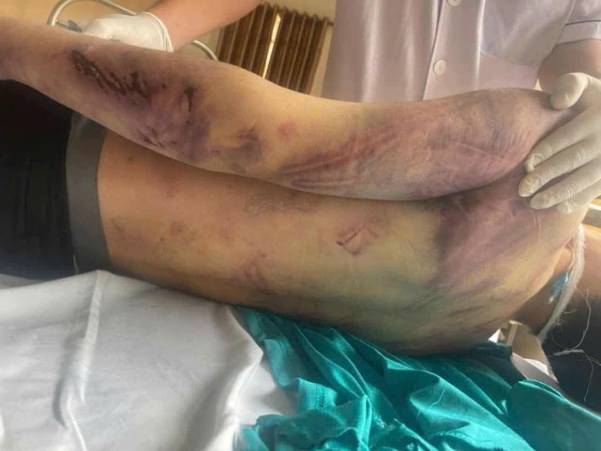 Cơ thể bầm tím của cháu Nam trước khi tử vong. Ảnh: GĐCC