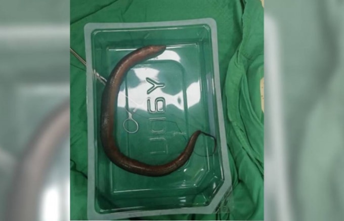 Con lươn được lấy ra trong bụng bệnh nhân ở Hồ Nam, Trung Quốc. Ảnh: