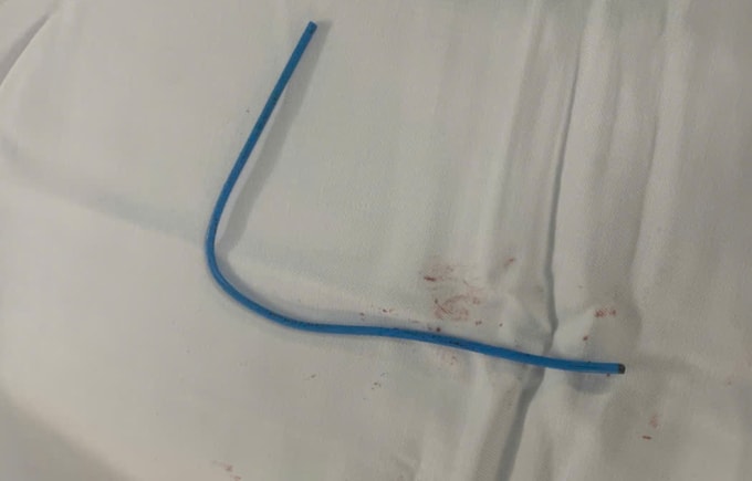 Dị vật được lấy ra ngoài. Ảnh: Bệnh viện cung cấp