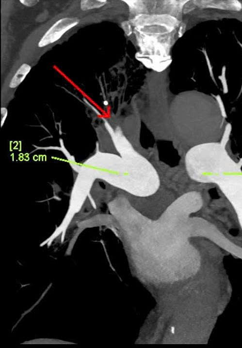 Chụp CT ngực cho thấy huyết khối lấp đầy lòng nhiều nhánh động mạch phổi phải (mũi tên đỏ). Ảnh: Bệnh viện Đa khoa Tâm Anh