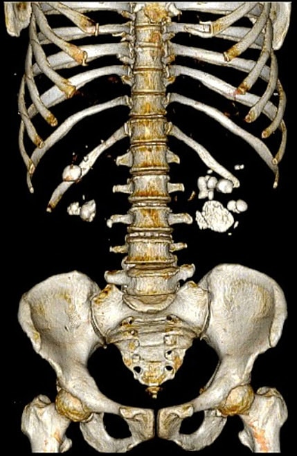 Ảnh chụp CT sỏi bám chi chít trong hai quả thận người phụ nữ. Ảnh: Bác sĩ cung cấp