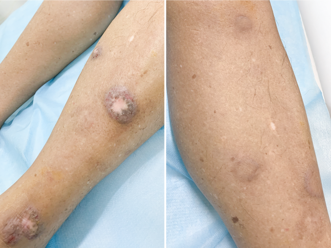 Các sẩn ngứa không còn dày sừng và gây ngứa sau 3 lần tiêm triamcinolone. Ảnh: Bệnh viện Đa khoa Tâm Anh