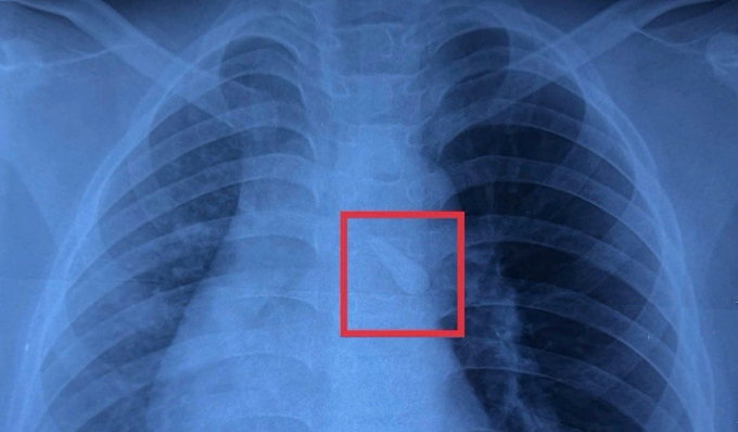 Hình ảnh X-quang cho thấy dị vật cản quang trong khí quản. Ảnh: Bệnh viện cung cấp