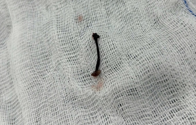 Con vắt trong mũi bé trai 2,5 tuổi được bác sĩ lấy ra ngoài. Ảnh: Kim Ny