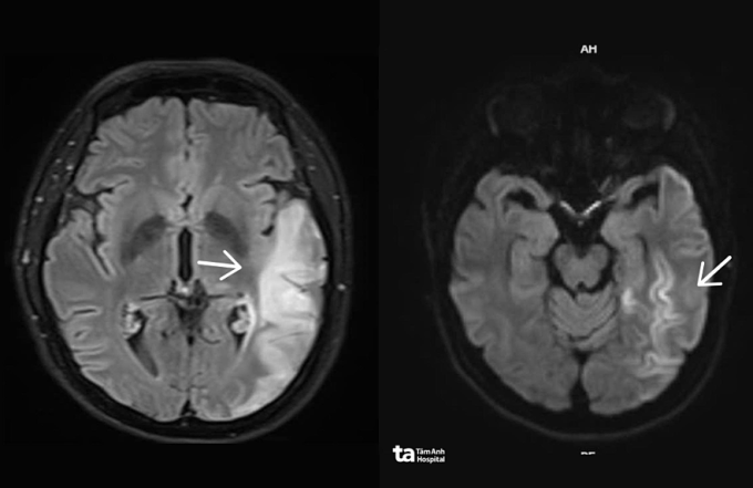 Ảnh MRI 3 Tesla cho thấy tổn thương não của chị Thu lan rộng bất thường. Ảnh: Bệnh viện Đa khoa Tâm Anh