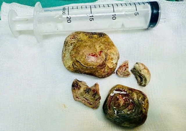 Người đàn ông 43 tuổi "bụng cứng như đá", bác sĩ phát hiện bí mật "đáng sợ" - Ảnh 1.