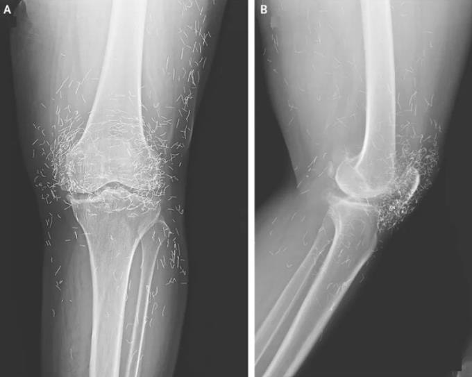 Hình ảnh X-quang mặt trước (A) và mặt bên (B) khớp gối trái của bệnh nhân cho thấy những đường mảnh xuất hiện trong hình chính là các sợi chỉ bằng vàng siêu nhỏ. Ảnh: The New England Journal of Medicine