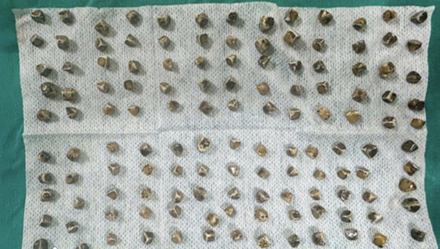 Đau bụng đi khám, người phụ nữ 40 tuổi sốc khi bác sĩ gắp ra thứ "đáng sợ" bên trong - Ảnh 1.