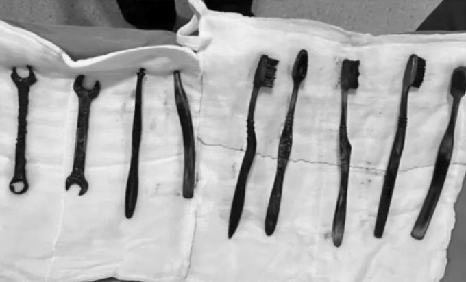 Bàn chải và hai cờ lê được lấy ra từ dạ dày bệnh nhân. Ảnh: Mohd. Moin