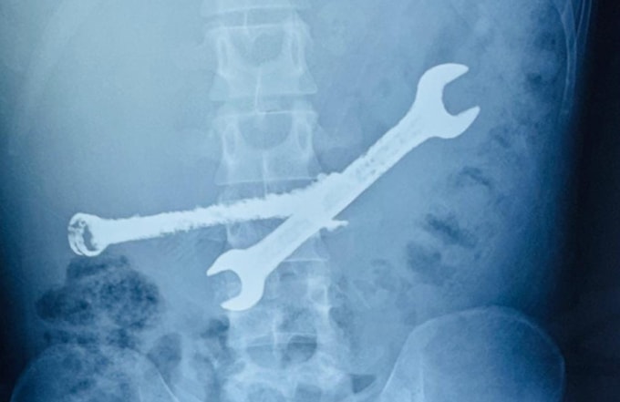 Hình ảnh siêu âm phát hiện cờ lê sắt trong bụng người đàn ông 26 tuổi. Ảnh: Tanmay Pareek