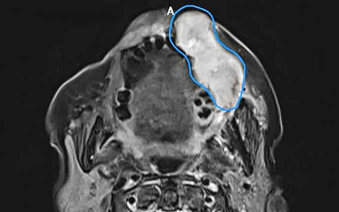 Ảnh CT ghi nhận khối u ác tính (vùng màu xanh) từ niêm mạc miệng xâm lấn ra má, môi người bệnh. Ảnh: Bệnh viện Đa khoa Tâm Anh