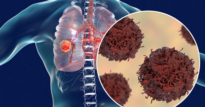 Mô phỏng ung thư phổi. Ảnh: Pinterest