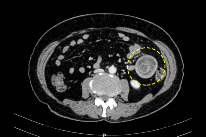 Khối lồng ruột trên phim chụp CT. Ảnh: Bệnh viện Đa khoa Tâm Anh
