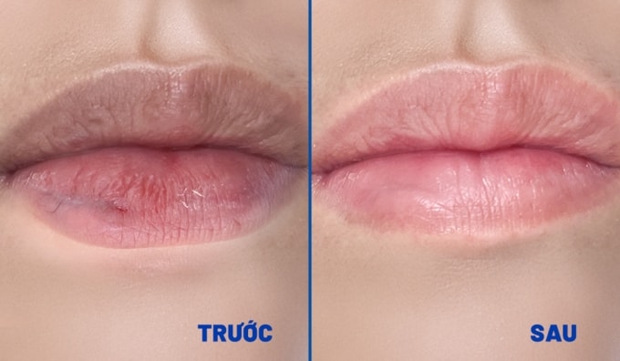 Phần sẹo trên môi của chị Mai đã giảm sưng, cải thiện sau hai lần tiêm triamcinolone (bên phải). Ảnh: Bệnh viện Đa khoa Tâm Anh