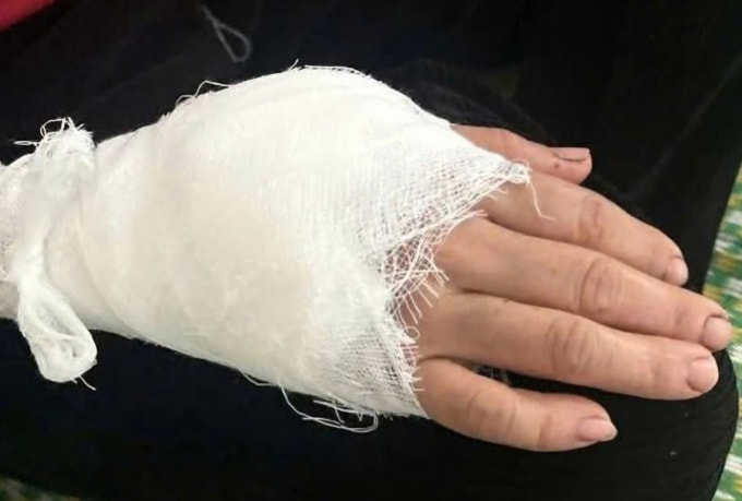 Khỉ tấn công khiến bà Chiến bị thương phải khâu 15 mũi. Ảnh: Lam Sơn