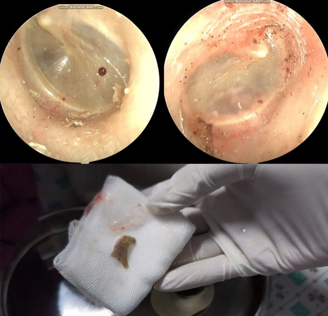 Người phụ nữ 60 tuổi tai ngứa như kim châm, bác sĩ gắp ra thứ "đáng sợ" bên trong - Ảnh 1.