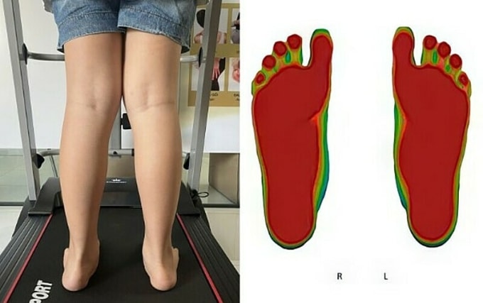 Dấu hiệu bàn chân bẹt ở trẻ. Ảnh: Maple Healthcare