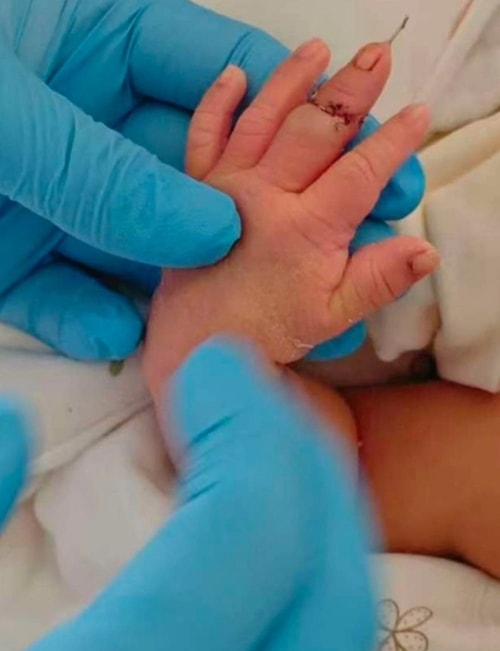 Nữ hộ sinh bị đình chỉ vì vô tình cắt đứt ngón tay của bé trai - Ảnh 1.