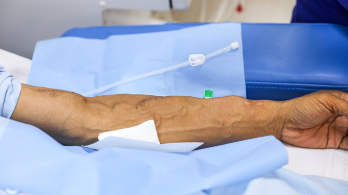 Bệnh nhân chạy thận nhân tạo tại Bệnh viện Thống Nhất, TP HCM. Ảnh: Phùng Tiên