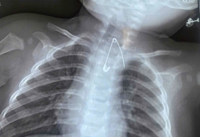 Kim băng nằm trong thực quản của bé trai 7 tháng tuổi. Ảnh: Bệnh viện cung cấp