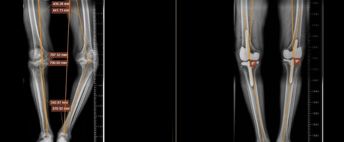 Phim chụp X-quang hai chân ông Tri trước (trái) và sau khi thay khớp. Ảnh: Bệnh viện Đa khoa Tâm Anh