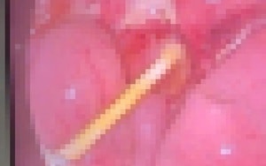 Nuốt nhầm bàn chải đánh răng, người phụ nữ nhập viện cấp cứu trong đêm - Ảnh 2.