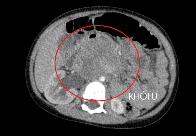 Khối u kích thước lớn, chèn ép thận và di căn. Ảnh: Bệnh viện cung cấp