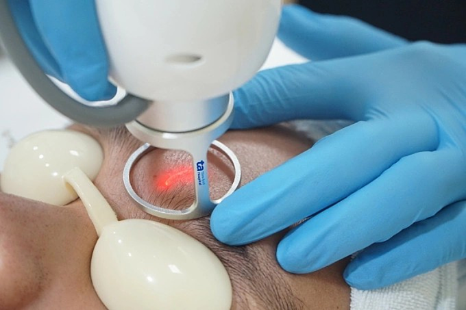 Bác sĩ Bệnh viện Đa khoa Tâm Anh TP HCM điều trị sẹo rỗ ở trán cho một nam bệnh nhân. Ảnh: Anh Thư