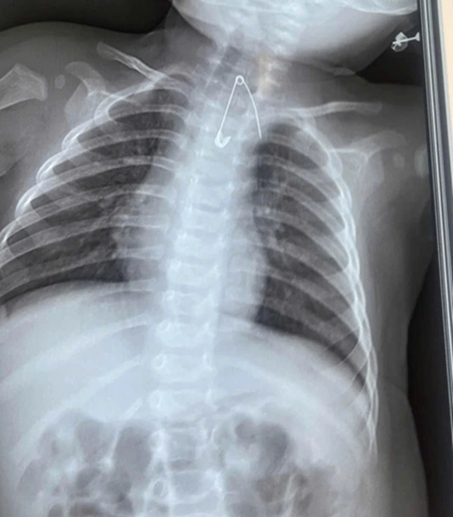 Bé 7 tháng tuổi khò khè kéo dài, bác sĩ phát hiện bí mật "đáng sợ" - Ảnh 1.