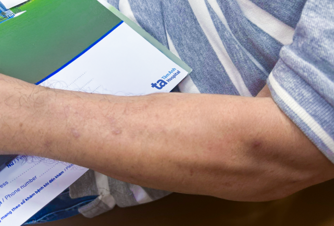 Các tổn thương da của anh Phát giảm rõ, hết ngứa sau 3 tháng điều trị. Ảnh: Bệnh viện Đa khoa Tâm Anh