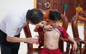 Lây thủy đậu từ con gái, người đàn ông khỏe mạnh rơi vào nguy kịch - Ảnh 4.