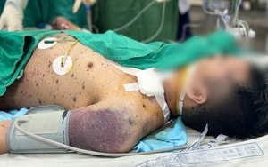 Lây thủy đậu từ con gái, người đàn ông khỏe mạnh rơi vào nguy kịch - Ảnh 3.