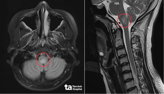 Ảnh MRI 3 Tesla cho thấy các tổn thương của Nhi phân bố dọc trục thần kinh trung ương. Ảnh: Bệnh viện Đa khoa Tâm Anh