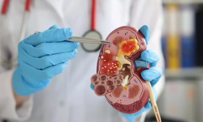 Việc liên tục xử lý nồng độ natri cao khiến hệ thống lọc máu phải làm việc ở cường độ tối đa. Ảnh minh họa: Times of India