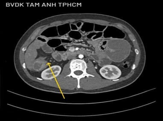 Kết quả chụp CT 100.000 lát cắt cho thấy khối u lớn (mũi tên vàng) gần góc gan. Ảnh: Bệnh viện Đa khoa Tâm Anh