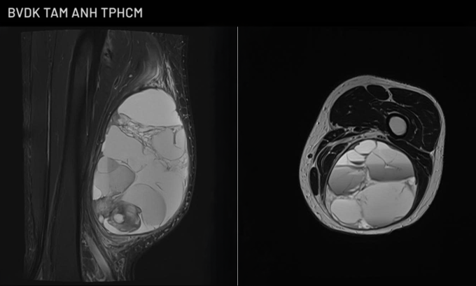 Kết quả chụp MRI cho thấy tổn thương choán chỗ lớn trong mô mềm ở mặt sau đùi trái của ông Thành. Ảnh: Bệnh viện Đa khoa Tâm Anh