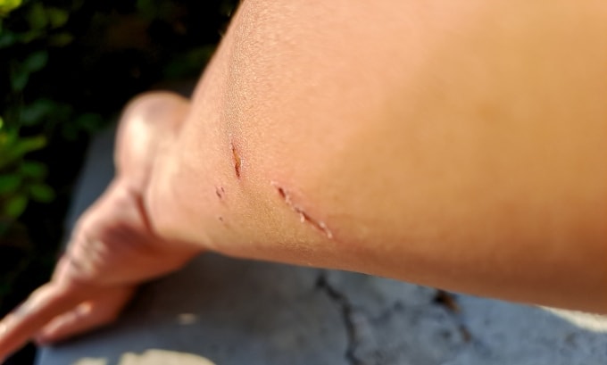 Vết thương do bị chó, mèo cắn, từ đây, virus dại có thể xâm nhập. Ảnh minh họa: Vecteezy