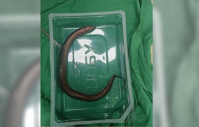 Đi siêu âm, người đàn ông sốc nặng khi thấy con vật "bơi" khủng trong bụng mình - Ảnh 1.