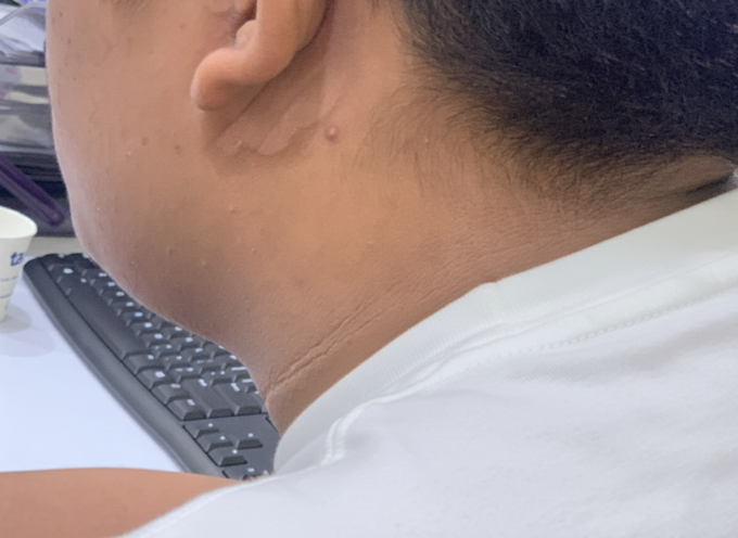 Gai đen quanh cổ Hưng là dấu hiệu đặc trưng của béo phì. Ảnh: Bệnh viện Đa khoa Tâm Anh