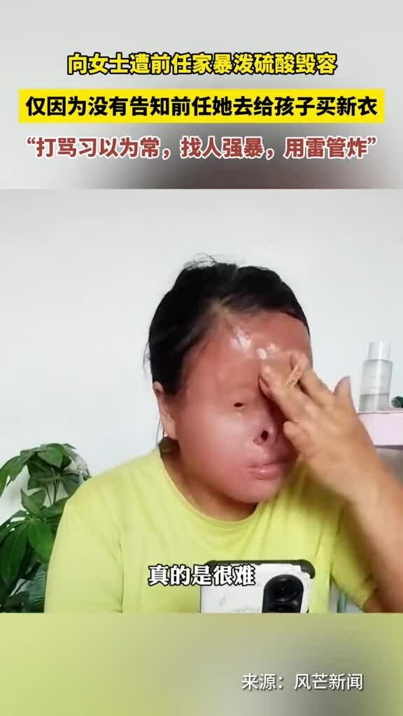 Người phụ nữ phải tự vẽ mắt, mũi sau khi bị chồng cũ tạt axit biến dạng